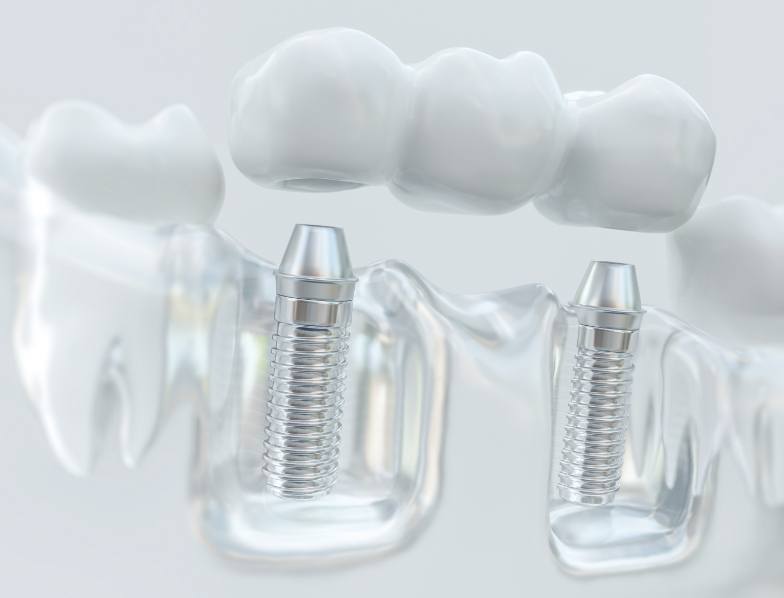 Model of two dental implants in the mouth